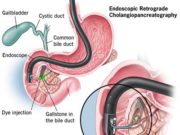 What are gallstones? The Best Diet with Gallstones. 7 Foods to Avoid with Gallstones List Diet with Gallstones, Gallstones, Foods to Avoid with Gallstones List, gallstones diet, Best Diet with Gallstones