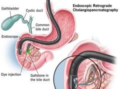 What are gallstones? The Best Diet with Gallstones. 7 Foods to Avoid with Gallstones List Diet with Gallstones, Gallstones, Foods to Avoid with Gallstones List, gallstones diet, Best Diet with Gallstones