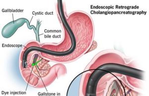 What are gallstones? The Best Diet with Gallstones. 7 Foods to Avoid with Gallstones List Diet with Gallstones, Gallstones, Foods to Avoid with Gallstones List, gallstones diet, Best Diet with Gallstones