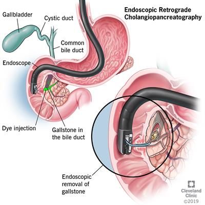 What are gallstones? The Best Diet with Gallstones. 7 Foods to Avoid with Gallstones List Diet with Gallstones, Gallstones, Foods to Avoid with Gallstones List, gallstones diet, Best Diet with Gallstones