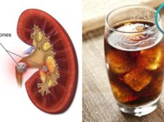 Can Diet Soda Cause Kidney Stones? Can diet soda cause kidney stones