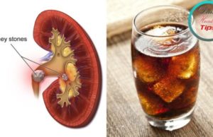 Can Diet Soda Cause Kidney Stones? Can diet soda cause kidney stones