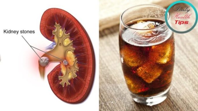 Kidney soda stones cause does very Can diet soda cause kidney stones